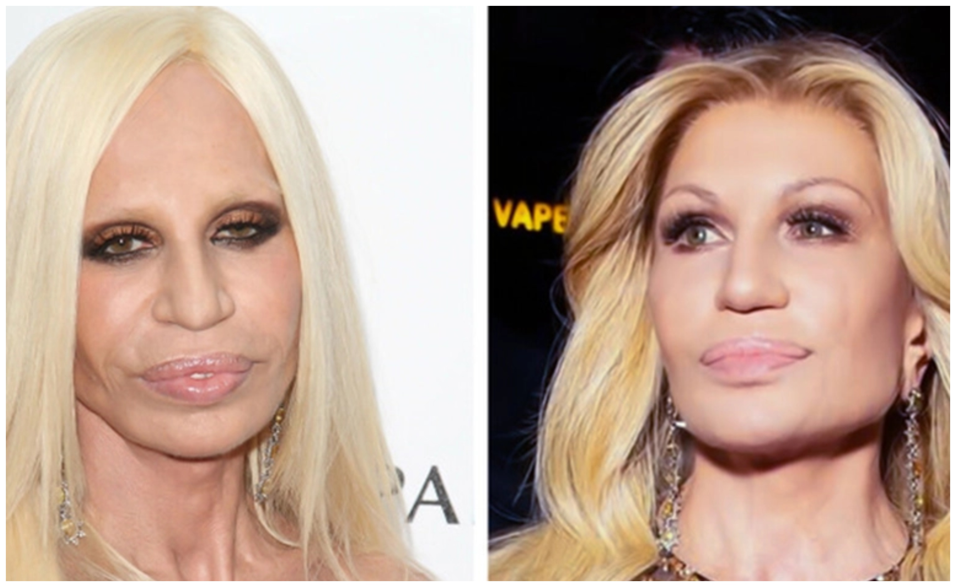 Αγνώριστη η Donatella Versace: Τι σχολιάζουν οι ειδικοί για τις αλλαγές στο πρόσωπό της