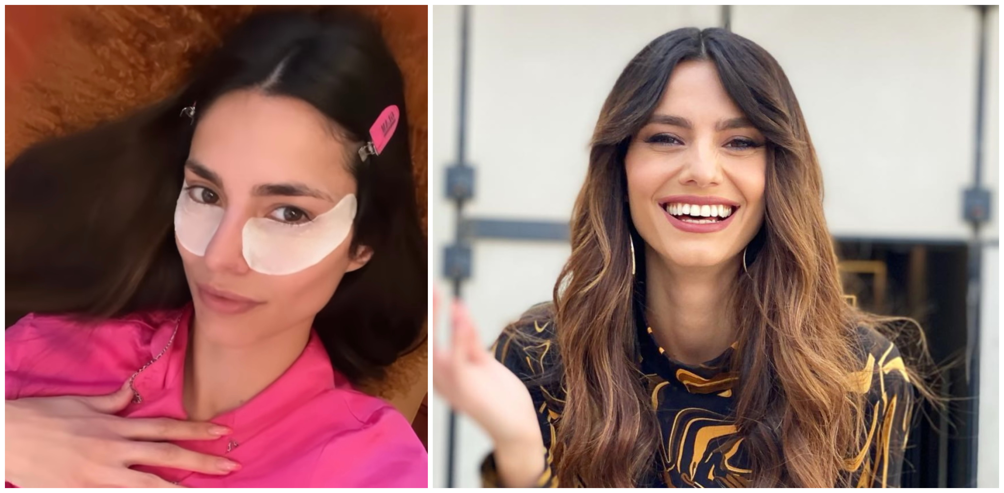 Πώς να εξαφανίσεις τους μαύρους κύκλους σε 5 λεπτά – Το μυστικό των cebebrities