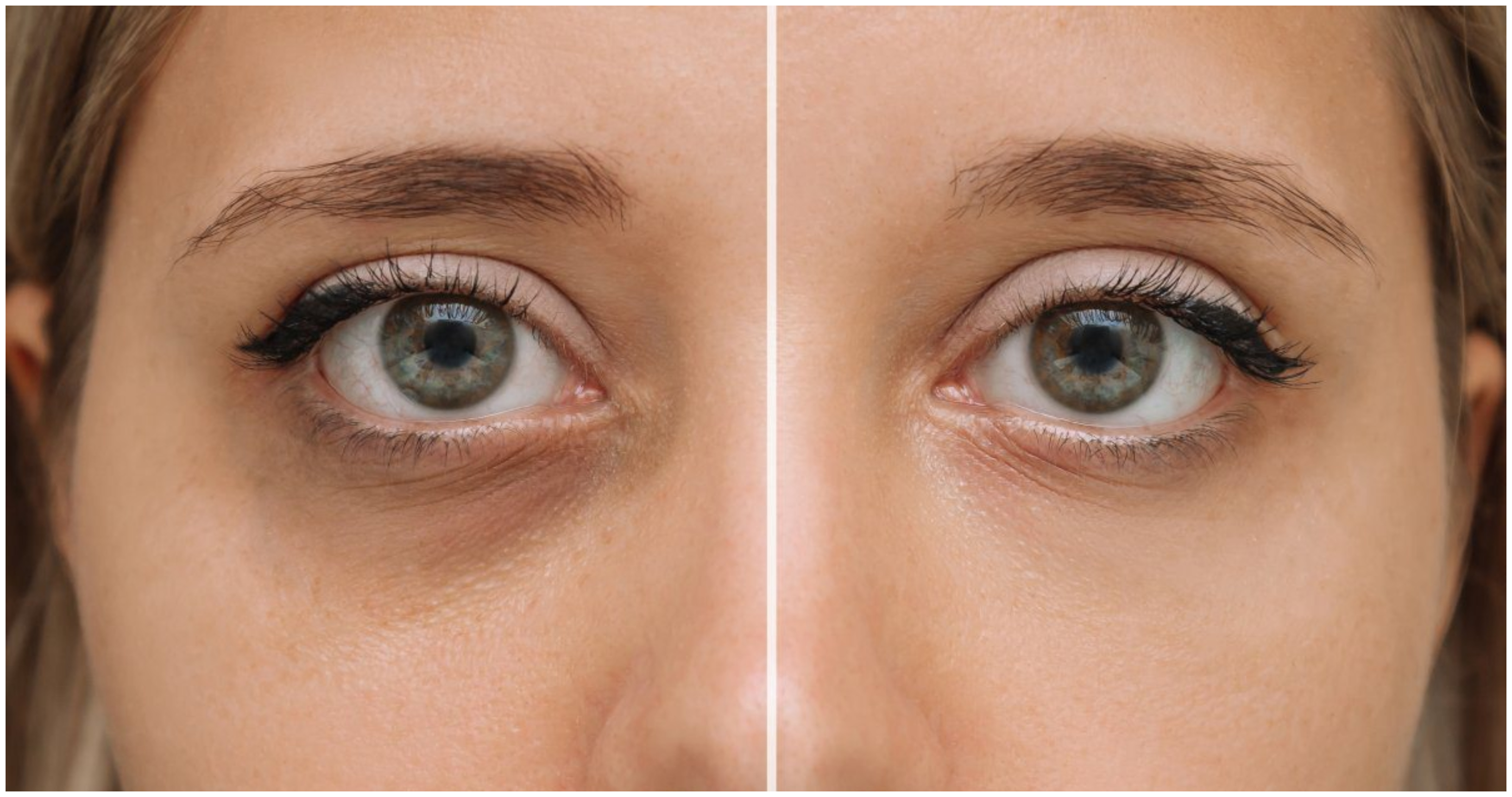Beauty secrets: Οι ειδικοί αποκαλύπτουν πώς να μειώσεις φυσικά τους μαύρους κύκλους